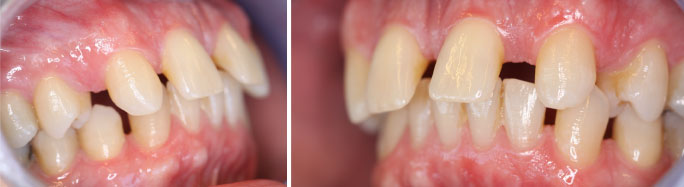 ontbrekende tanden case1c