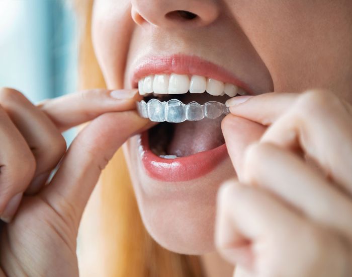 Invisalign